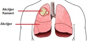 akciğer-kanseri